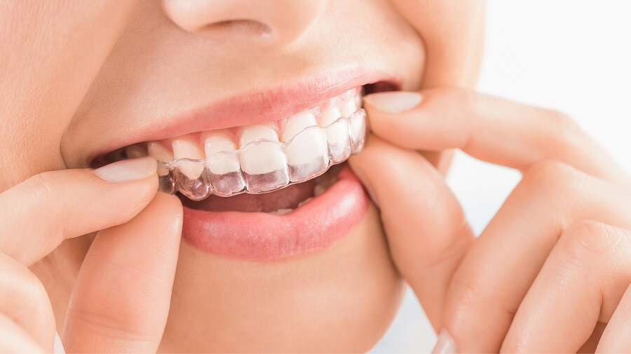 Clareamento dental caseiro em Brasília - Asa Norte - Clínica Melina Almeida Odontologia